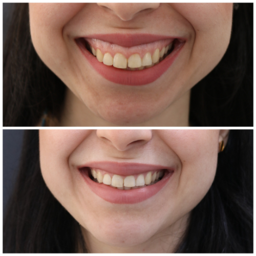 Before & After