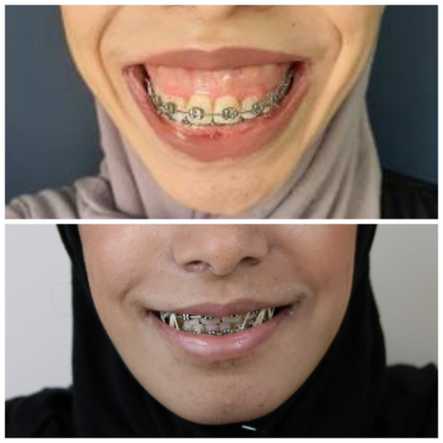 Before & After