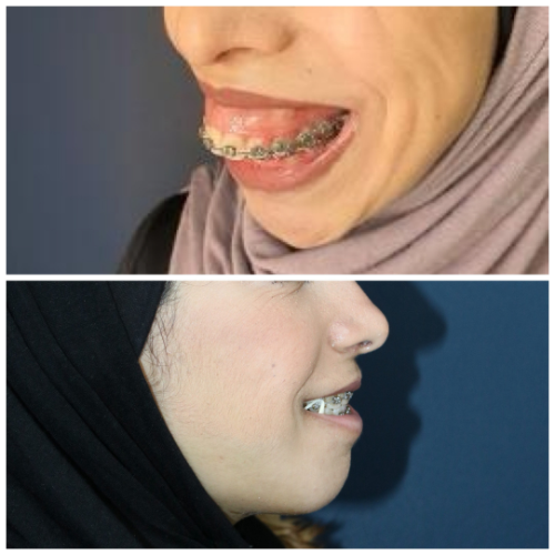 Before & After