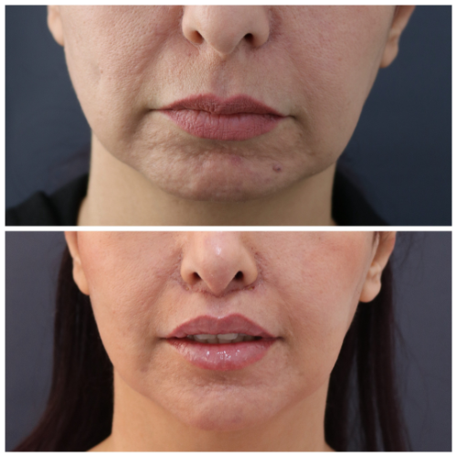Before & After