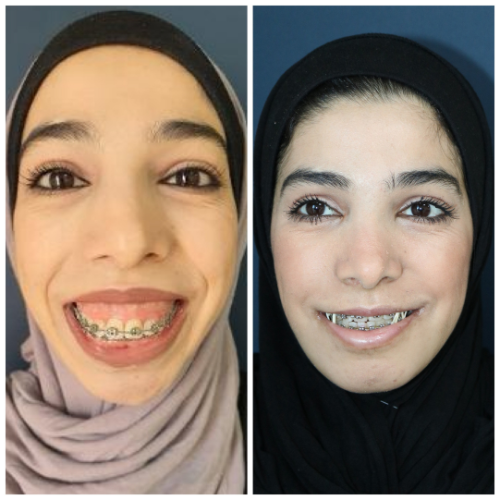 Before & After